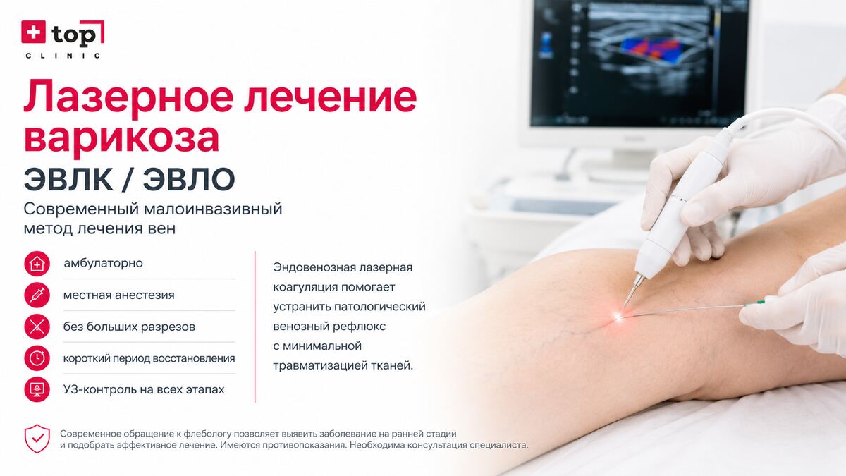 Лазерное лечение варикоза ЭВЛК / ЭВЛО под УЗ-контролем в TOP CLINIC